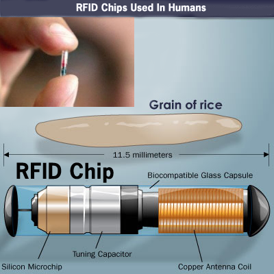 Rfid Chip Implantat Kosten